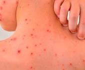 Rickettsiosis puede  llegar a ser "mortal"