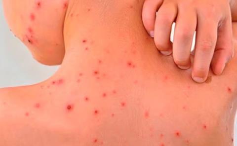 Rickettsiosis puede  llegar a ser "mortal"
