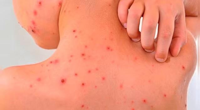 Rickettsiosis puede llegar a ser "mortal" Rickettsiosis puede llegar a ser "mortal"