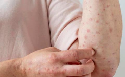 Alerta por casos de Sarampión 
