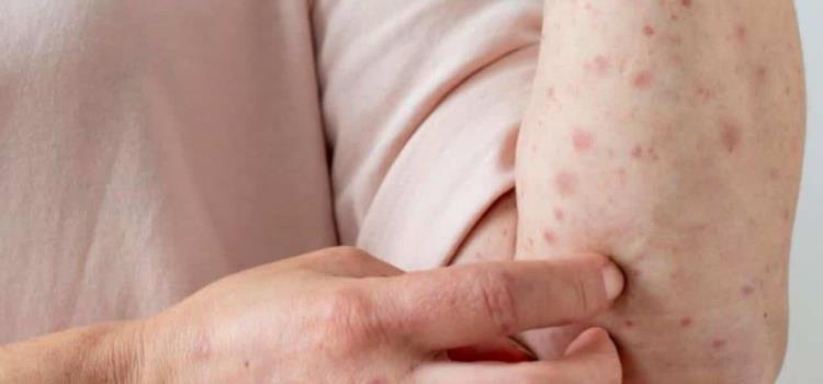 Alerta por casos de Sarampión 
