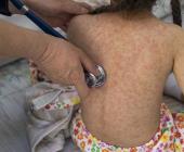 Emitieron alerta por casos de sarampión