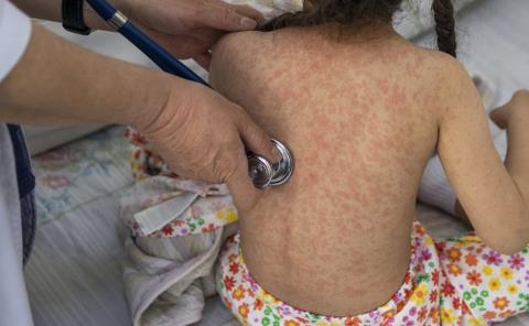 Emitieron alerta por casos de sarampión