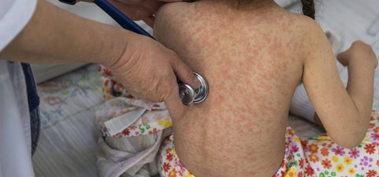Emitieron alerta por casos de sarampión Emitieron alerta por casos de sarampión