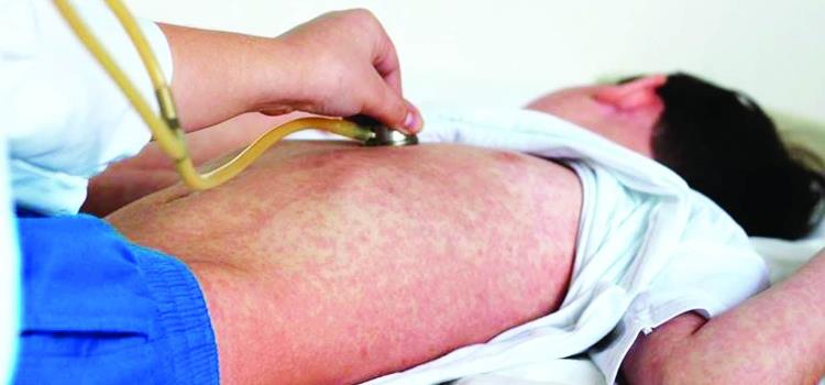 Más de mil casos de sarampión Más de mil casos de sarampión