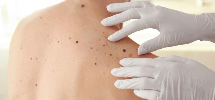 ALERTARON POR CÁNCER DE PIEL ALERTARON POR CÁNCER DE PIEL