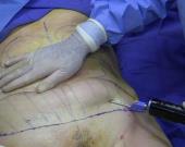 INFECTADAS TRAS UNA LIPOSUCCIÓN
