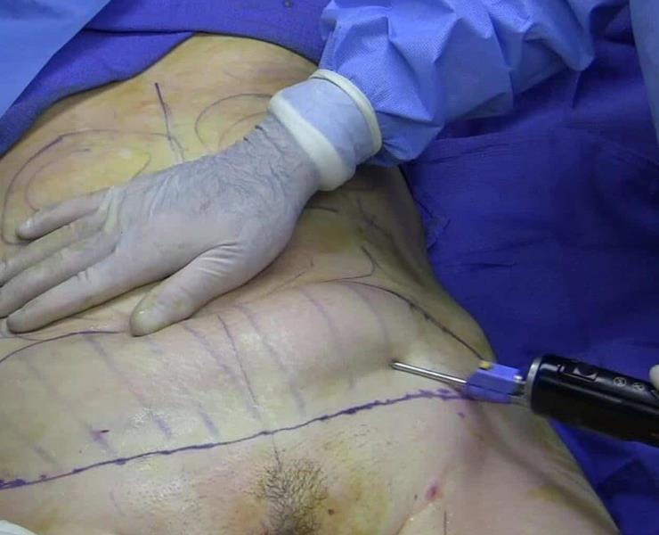 INFECTADAS TRAS UNA LIPOSUCCIÓN
