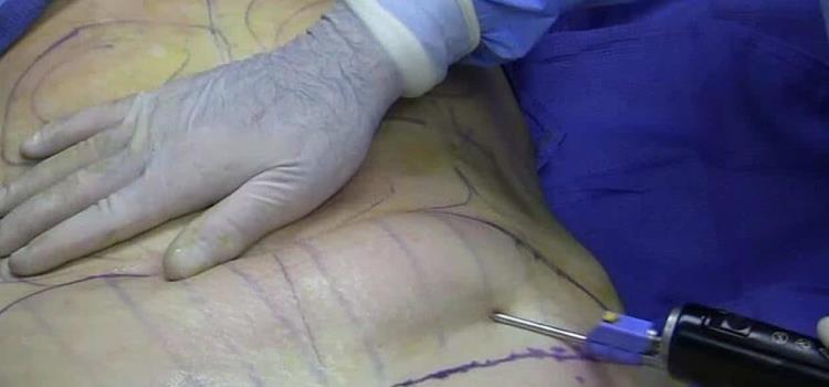 INFECTADAS TRAS UNA LIPOSUCCIÓN INFECTADAS TRAS UNA LIPOSUCCIÓN