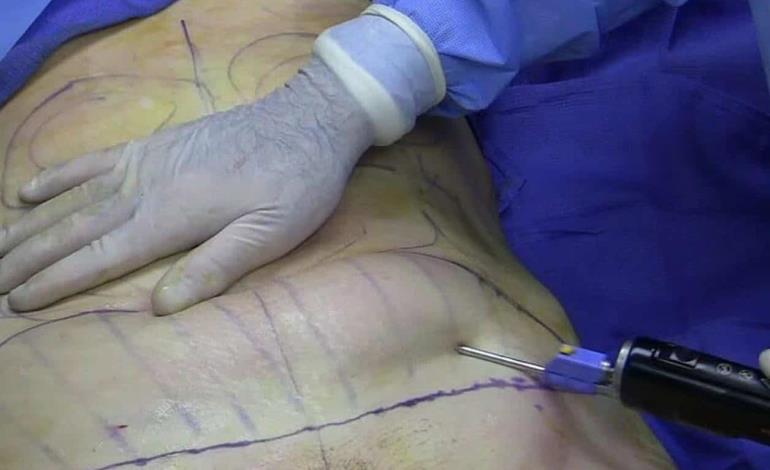 INFECTADAS TRAS UNA LIPOSUCCIÓN