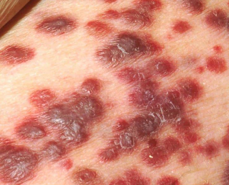 Alerta por cáncer de sarcoma: Ssa
