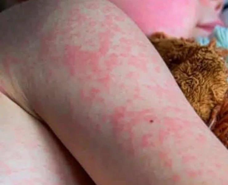 Parvovirus en humanos
