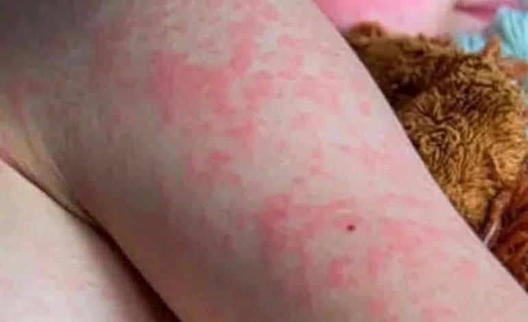 Parvovirus en humanos
