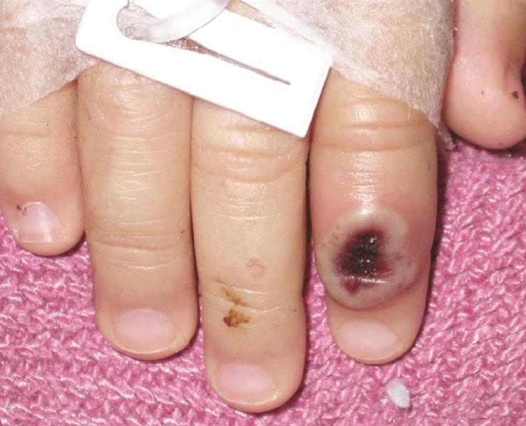 Muerto por viruela del mono