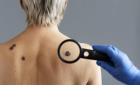 Detectan casos de cáncer de piel

