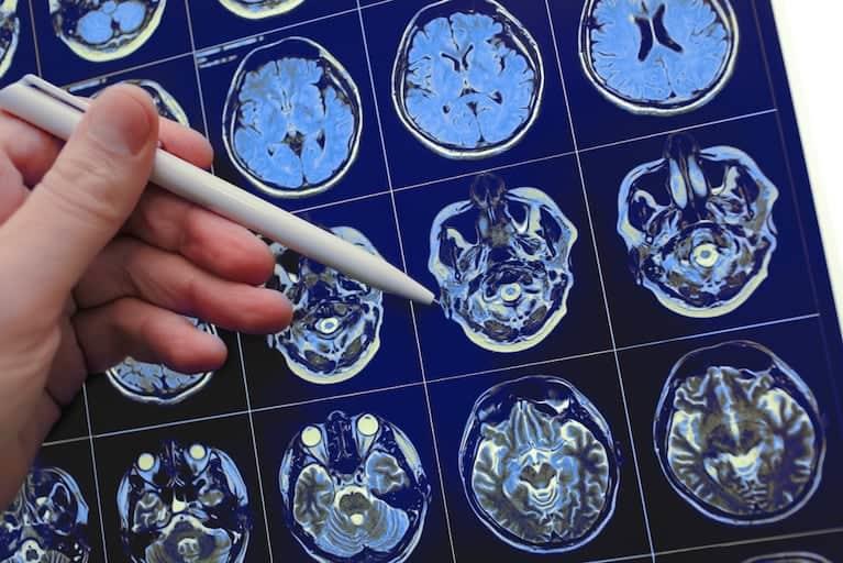CISTICERCOSIS CEREBRAL