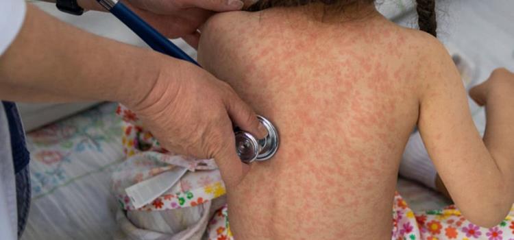 Confirma la SSA sólo  un caso de sarampión