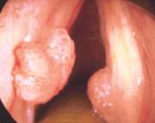 VPH detona diversos cánceres VPH detona diversos cánceres