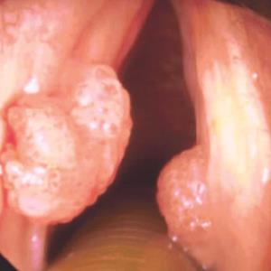 VPH detona diversos cánceres VPH detona diversos cánceres