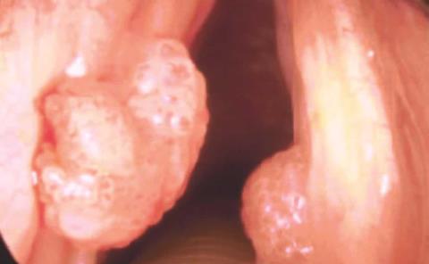 VPH detona diversos cánceres VPH detona diversos cánceres