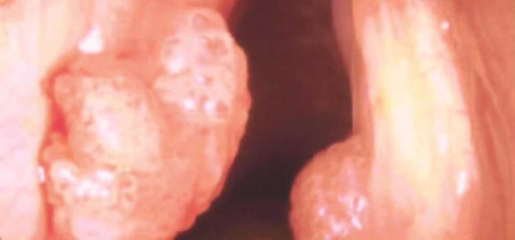 VPH detona diversos cánceres VPH detona diversos cánceres